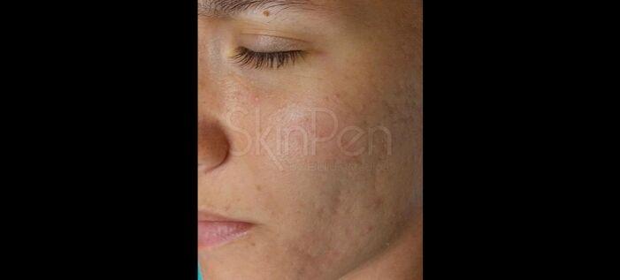 Vitalyc Medspa | Highland Park microneedling after — Dallas, TX