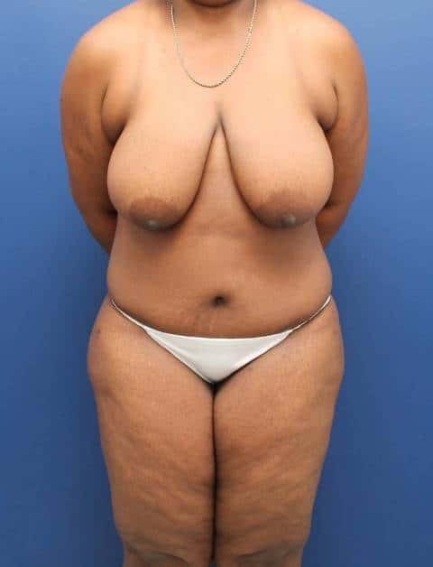 Baltimore Plastic Surgery tummy tuck after — Timonium, MD