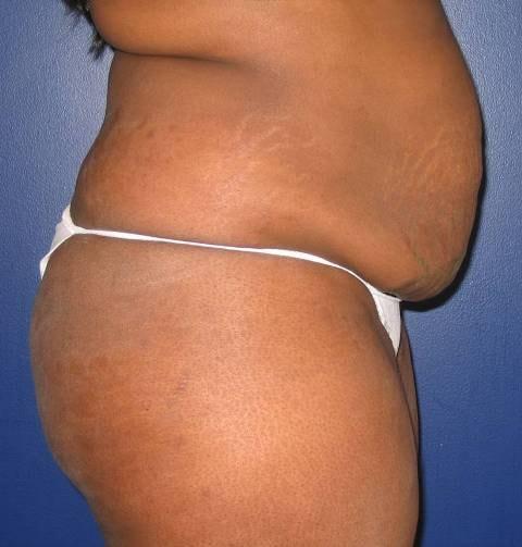 Brazilian Butt Lift before at Baltimore Plastic Surgery in Timonium, MD