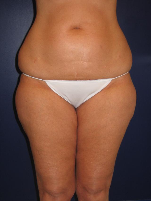 Brazilian Butt Lift before at Baltimore Plastic Surgery in Timonium, MD