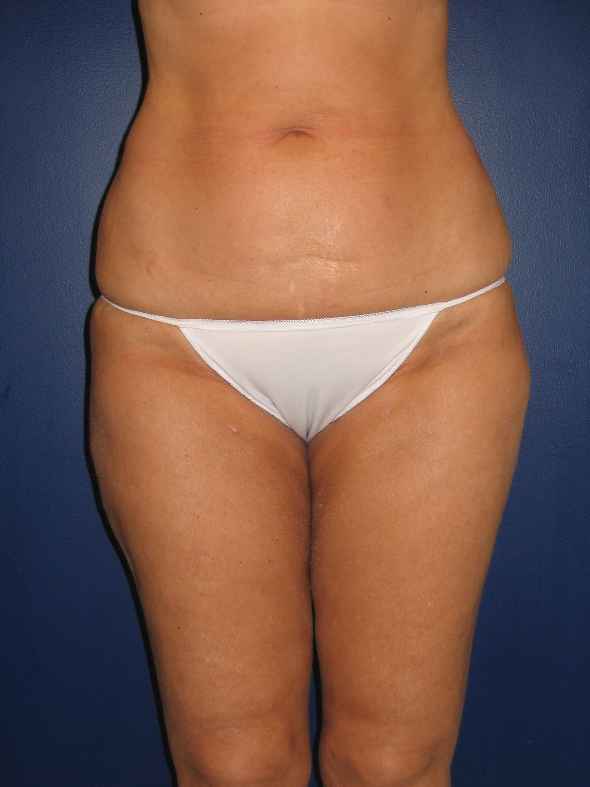 Baltimore Plastic Surgery liposuction after — Timonium, MD