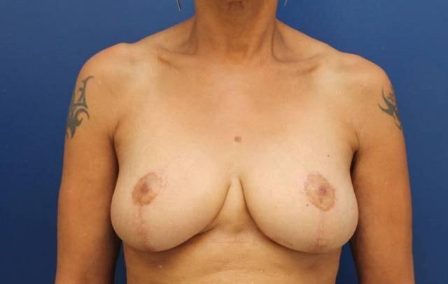 Baltimore Plastic Surgery breast lift after — Timonium, MD