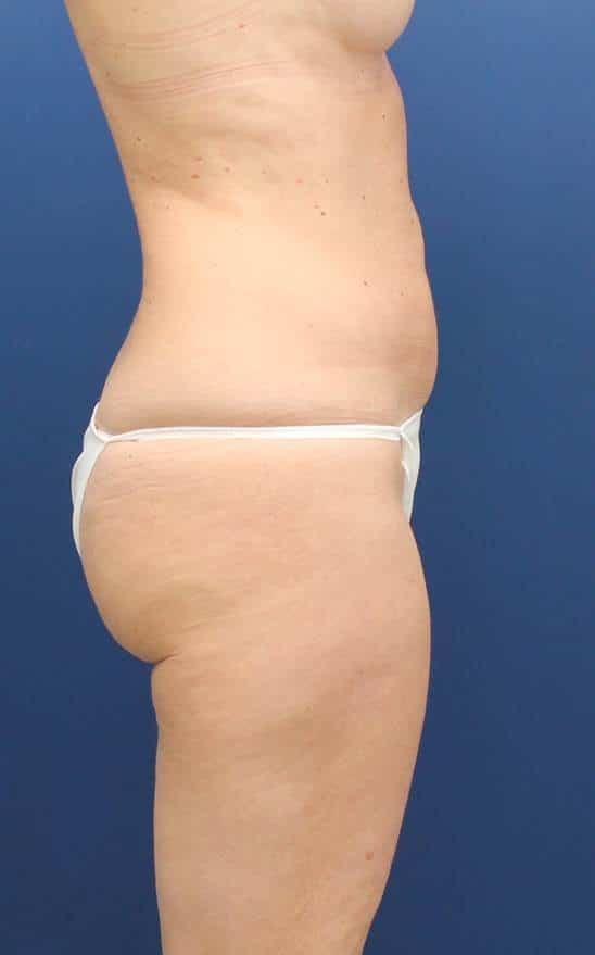 Baltimore Plastic Surgery liposuction after — Timonium, MD