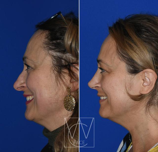 Rhinoplasty before at Joseph Shvidler, MD in Seattle, WA