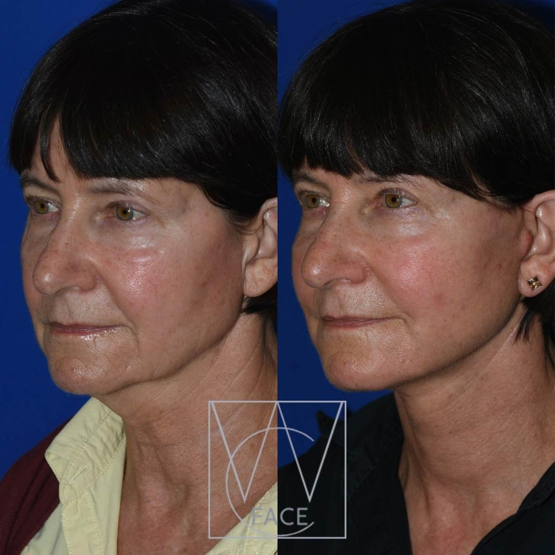 Joseph Shvidler, MD neck lift result — Seattle, WA