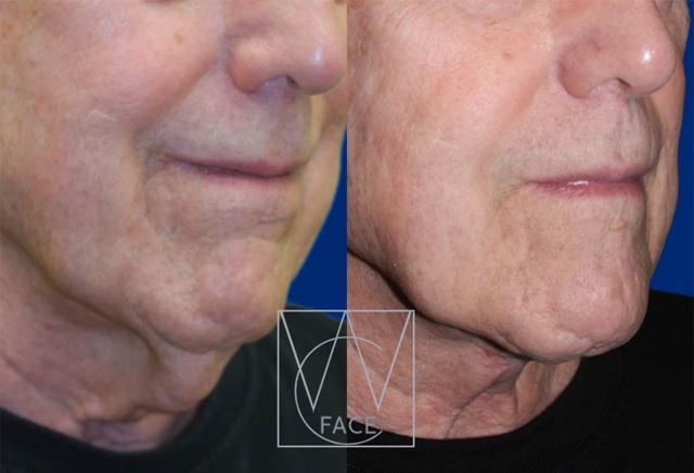 Neck Lift result at Joseph Shvidler, MD in Seattle, WA