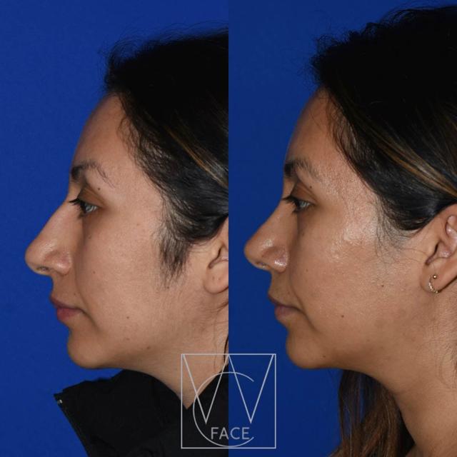 Rhinoplasty result at Joseph Shvidler, MD in Seattle, WA