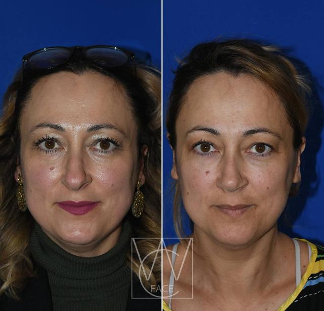 Rhinoplasty after at Joseph Shvidler, MD in Seattle, WA