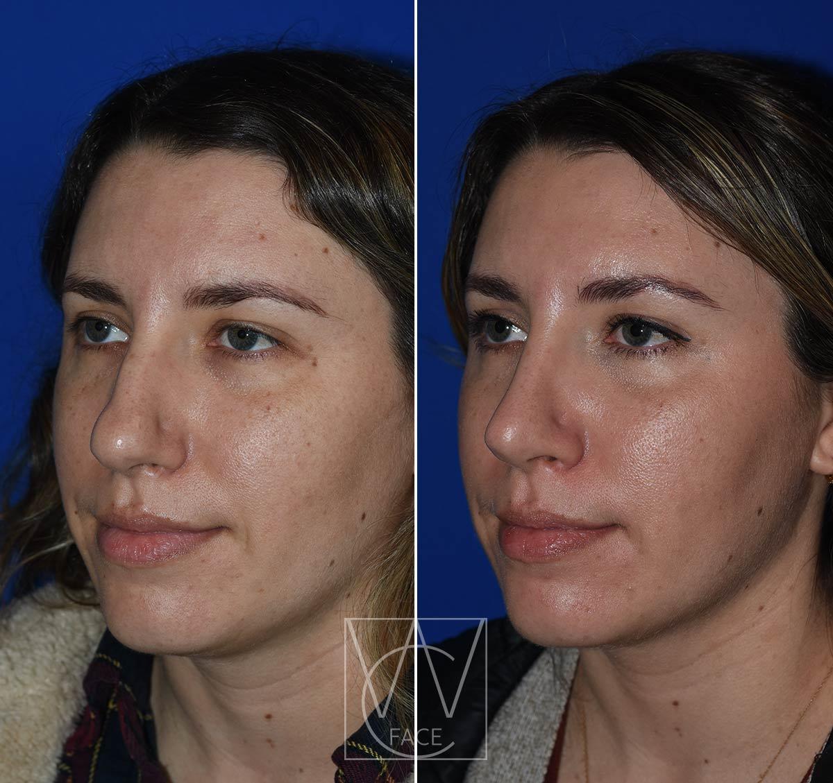 Joseph Shvidler, MD rhinoplasty result — Seattle, WA