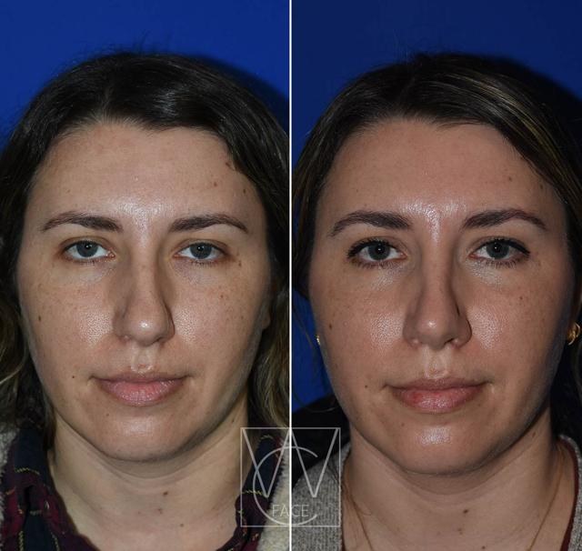 Rhinoplasty result at Joseph Shvidler, MD in Seattle, WA