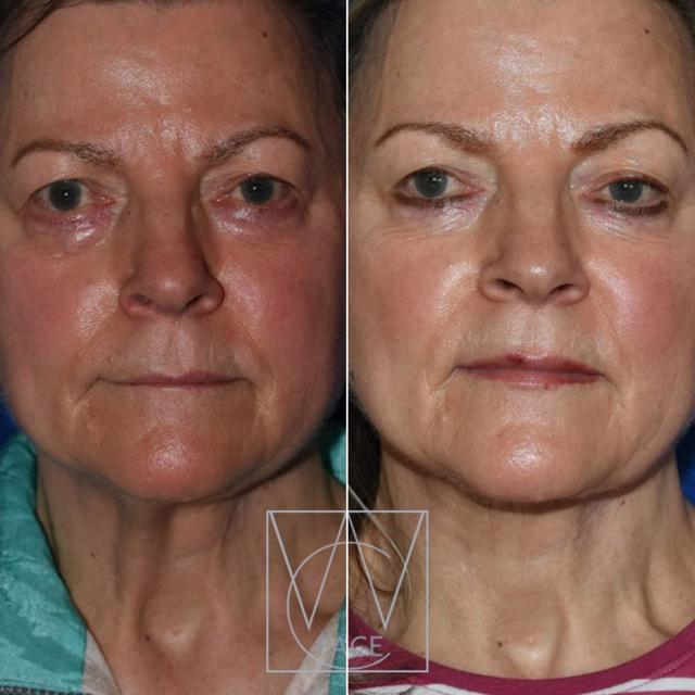 Neck Lift result at Joseph Shvidler, MD in Seattle, WA
