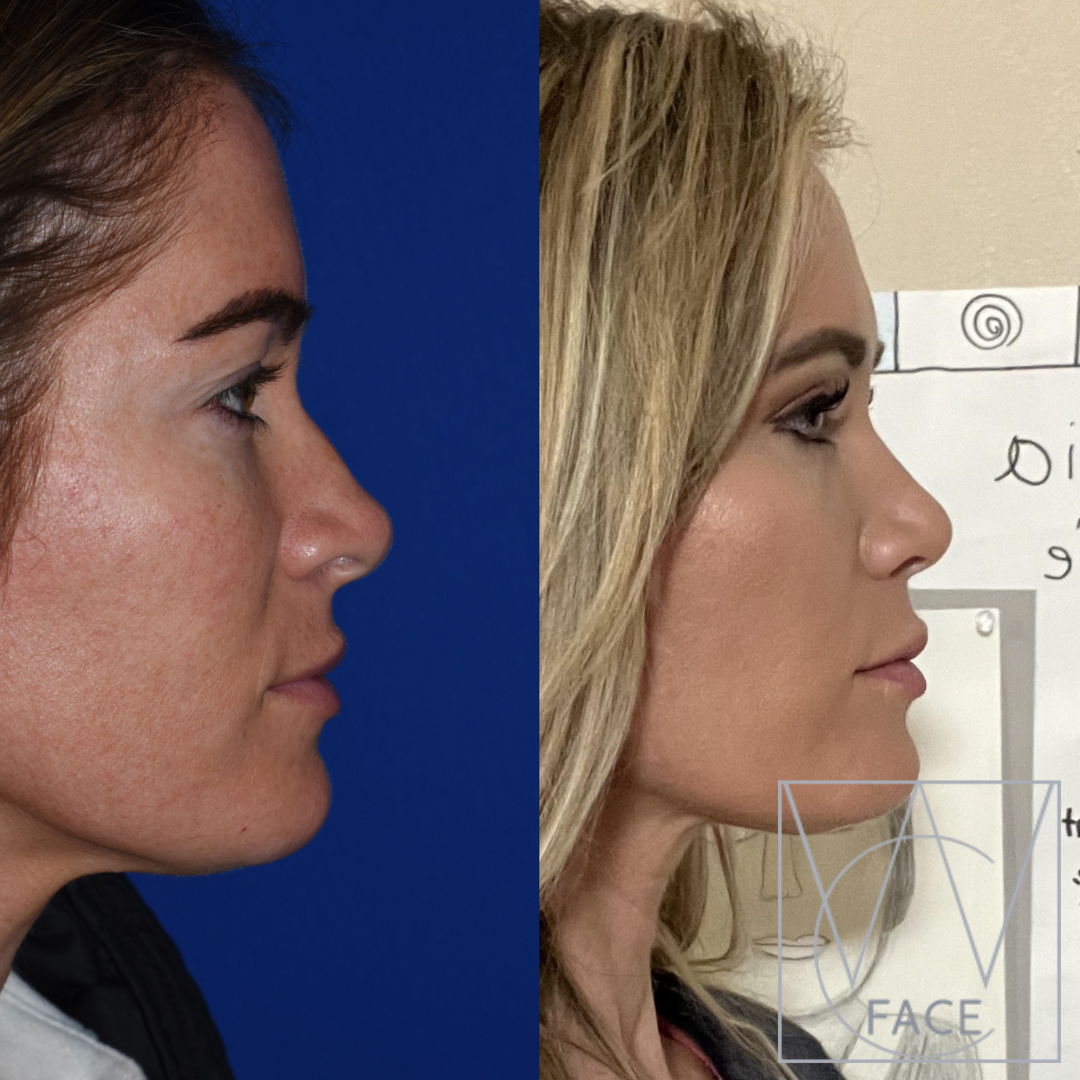 Joseph Shvidler, MD rhinoplasty result — Seattle, WA