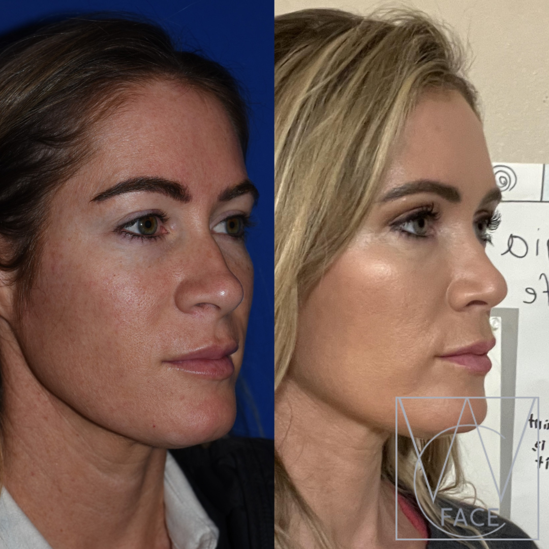 Joseph Shvidler, MD rhinoplasty result — Seattle, WA