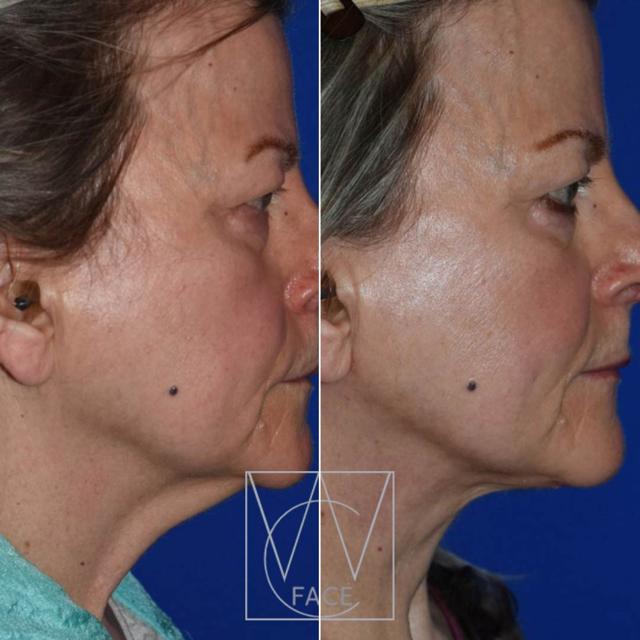 Neck Lift result at Joseph Shvidler, MD in Seattle, WA