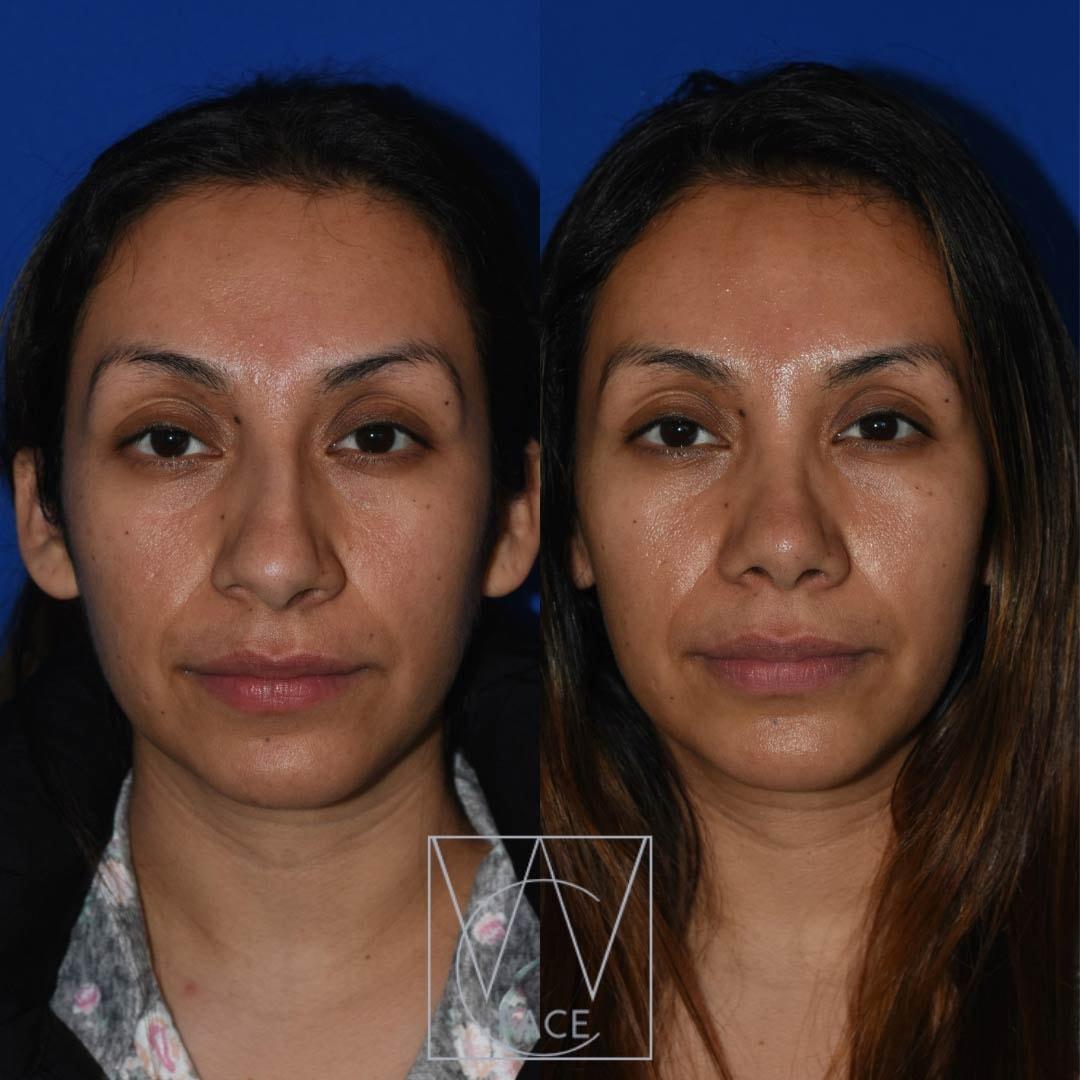 Joseph Shvidler, MD rhinoplasty result — Seattle, WA