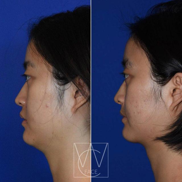 Neck Lift result at Joseph Shvidler, MD in Seattle, WA