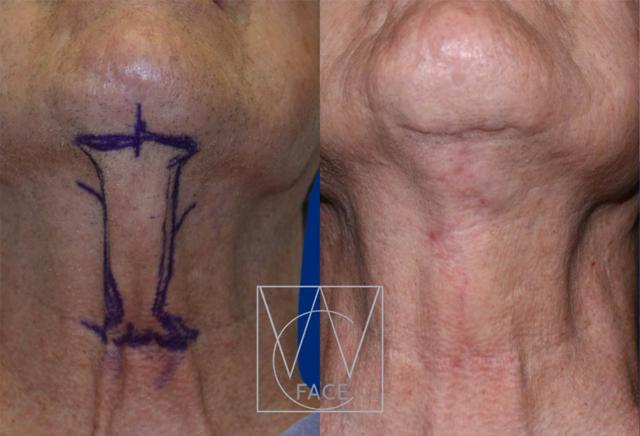 Neck Lift result at Joseph Shvidler, MD in Seattle, WA