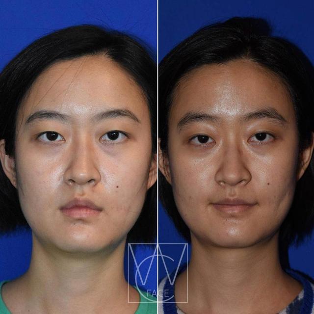 Neck Lift result at Joseph Shvidler, MD in Seattle, WA