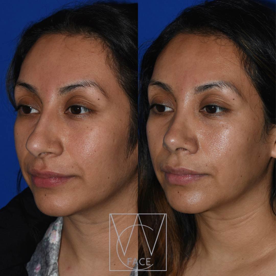 Joseph Shvidler, MD rhinoplasty result — Seattle, WA