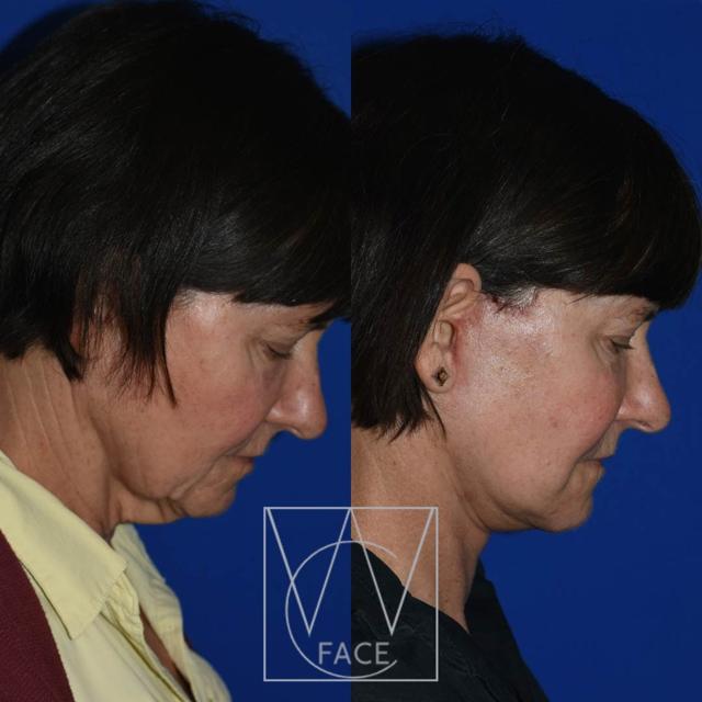 Deep Plane Facelift result at Joseph Shvidler, MD in Seattle, WA