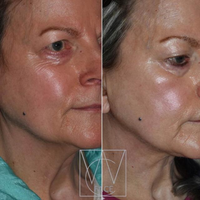 Neck Lift result at Joseph Shvidler, MD in Seattle, WA