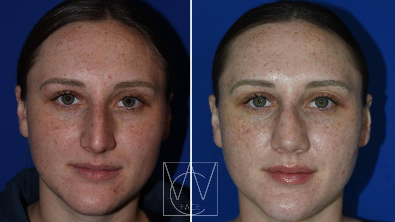 Joseph Shvidler, MD rhinoplasty result — Seattle, WA