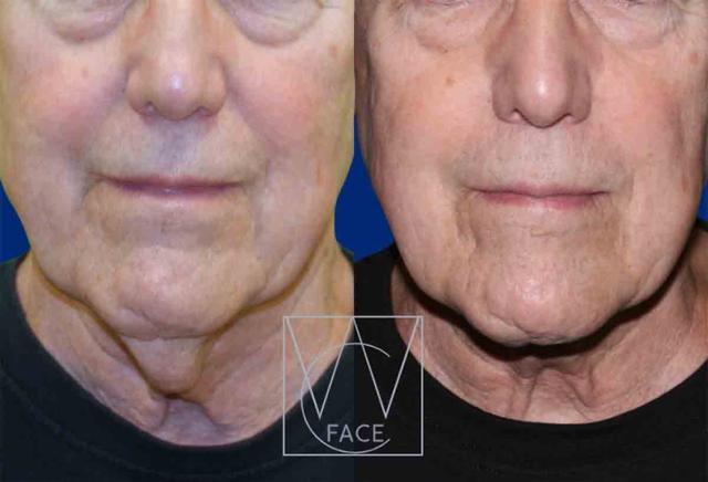 Deep Plane Facelift result at Joseph Shvidler, MD in Seattle, WA