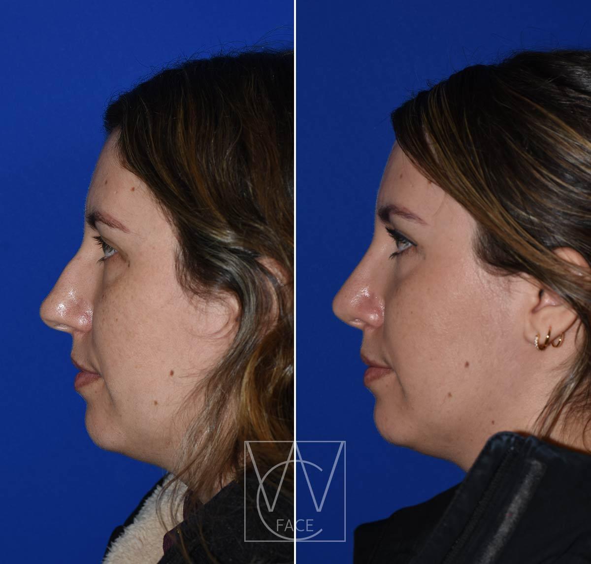 Joseph Shvidler, MD rhinoplasty result — Seattle, WA