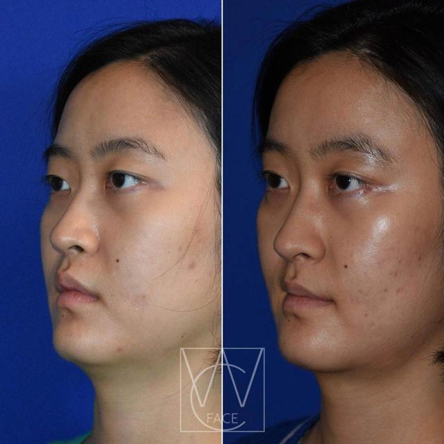 Neck Lift result at Joseph Shvidler, MD in Seattle, WA