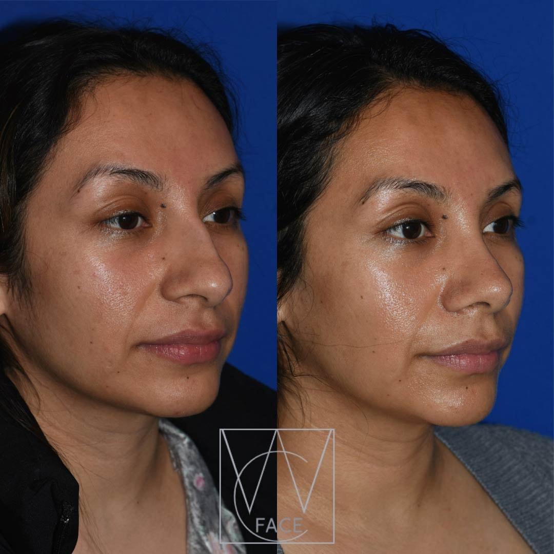 Joseph Shvidler, MD rhinoplasty result — Seattle, WA