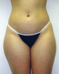 Liposuction before at The Brandow Clinic in Bala Cynwyd, PA