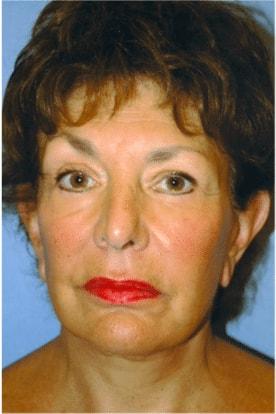 The Brandow Clinic facelift after — Bala Cynwyd, PA