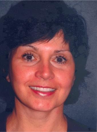 The Brandow Clinic facelift after — Bala Cynwyd, PA