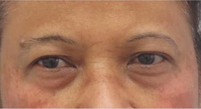 Blepharoplasty before at The Brandow Clinic in Bala Cynwyd, PA