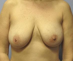 Breast Lift before at The Brandow Clinic in Bala Cynwyd, PA