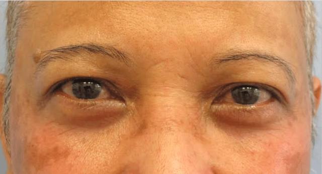 Blepharoplasty after at The Brandow Clinic in Bala Cynwyd, PA