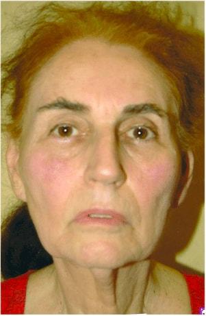 Deep Plane Facelift before at The Brandow Clinic in Bala Cynwyd, PA
