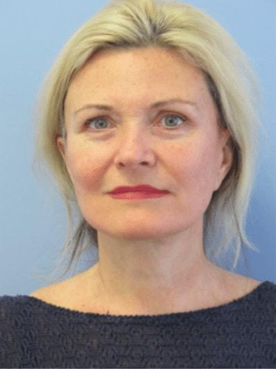 The Brandow Clinic facelift after — Bala Cynwyd, PA