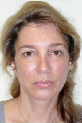 The Brandow Clinic facelift after — Bala Cynwyd, PA