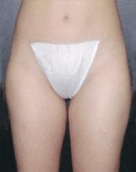 Liposuction after at The Brandow Clinic in Bala Cynwyd, PA