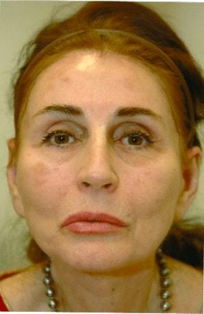 The Brandow Clinic facelift after — Bala Cynwyd, PA