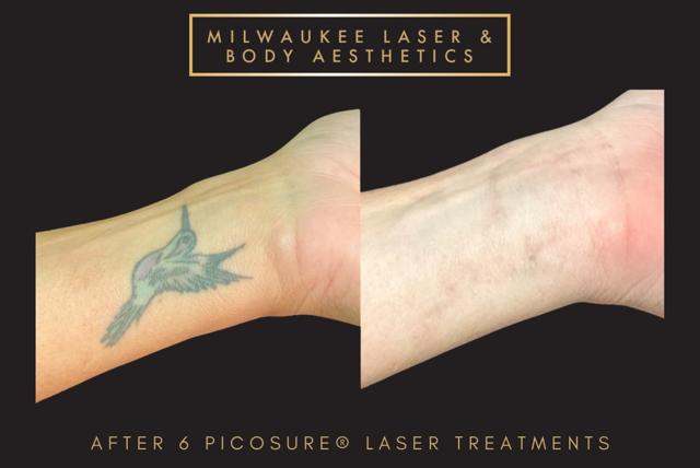 Laser Skin Resurfacing result at Milwaukee Laser & Body Aesthetics in Brookfield, WI