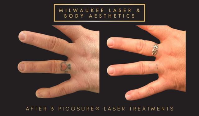 Chemical Peel result at Milwaukee Laser & Body Aesthetics in Brookfield, WI