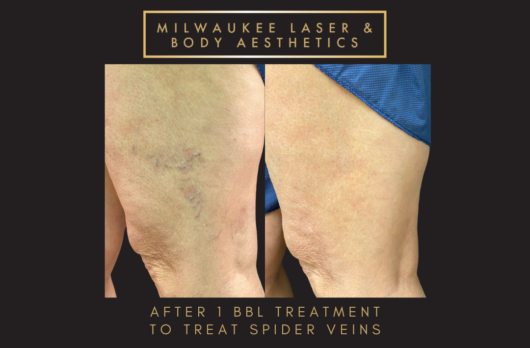 Milwaukee Laser & Body Aesthetics result — Brookfield, WI