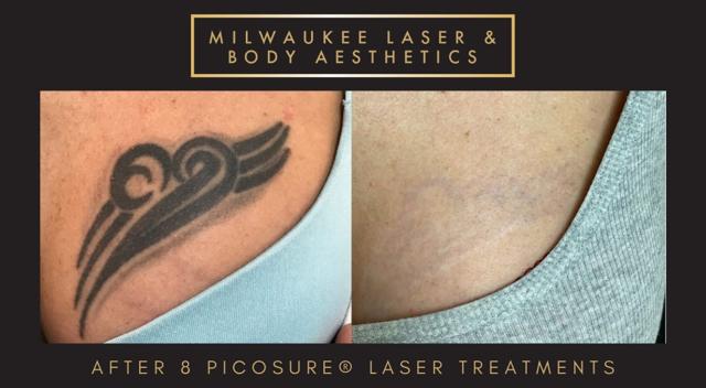 Laser Skin Resurfacing result at Milwaukee Laser & Body Aesthetics in Brookfield, WI