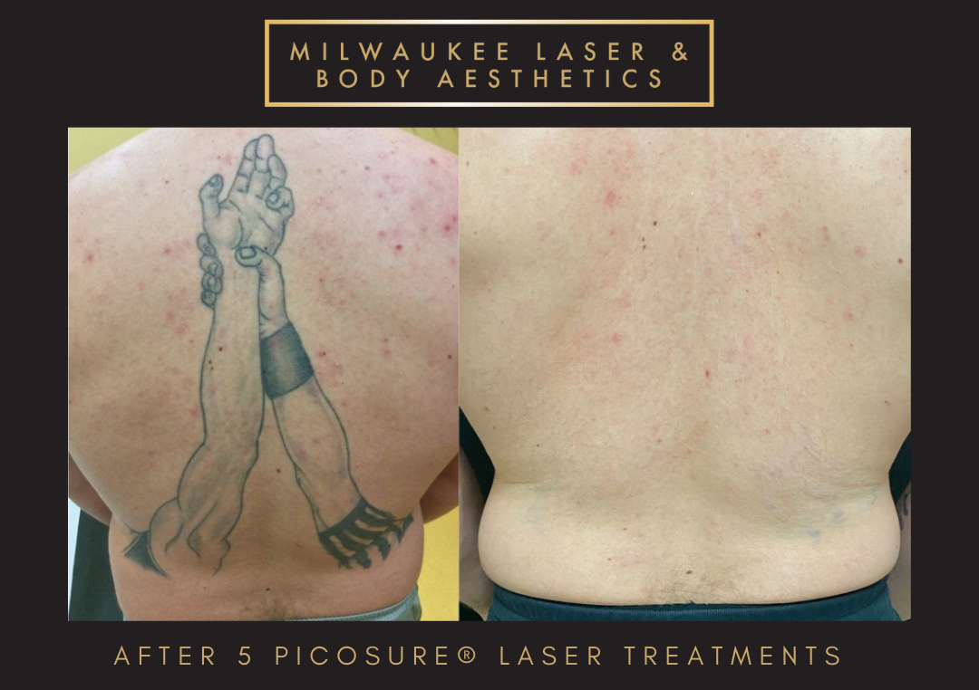 Milwaukee Laser & Body Aesthetics result — Brookfield, WI