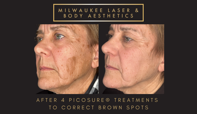 Morpheus8 result at Milwaukee Laser & Body Aesthetics in Brookfield, WI