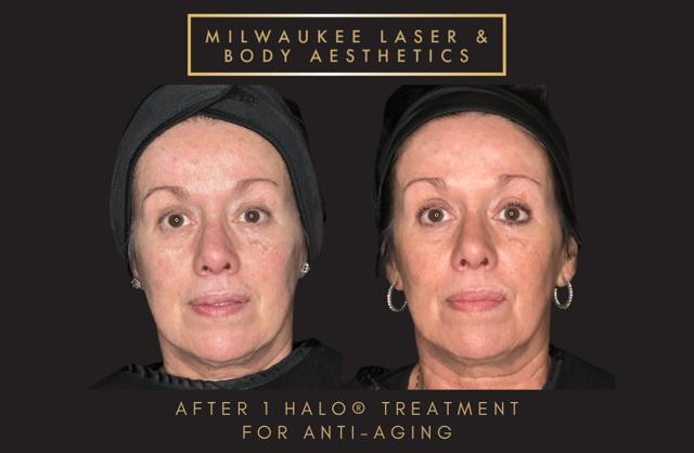 Laser Skin Resurfacing result at Milwaukee Laser & Body Aesthetics in Brookfield, WI