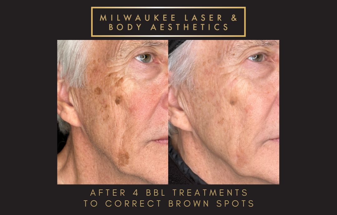 Milwaukee Laser & Body Aesthetics result — Brookfield, WI