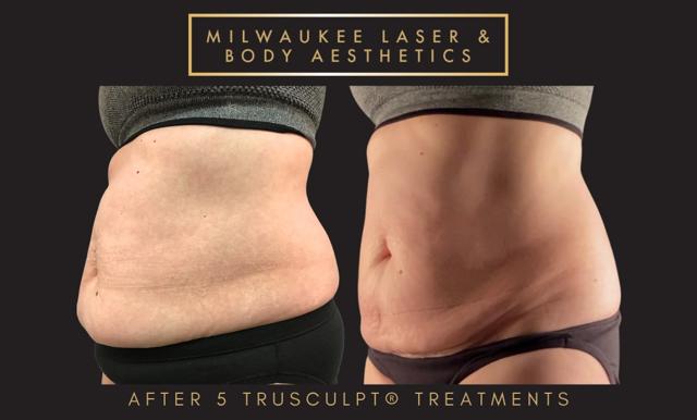 CoolSculpting result at Milwaukee Laser & Body Aesthetics in Brookfield, WI